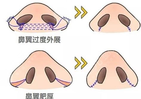 鼻翼