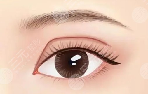 双眼皮