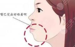 正颌手术医保可以报销吗?需要正畸吗?术前术后注意事项介绍 正颌手术医保可以报销吗?需要正畸吗?术前术后注意事项介绍