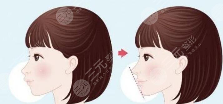 正颌