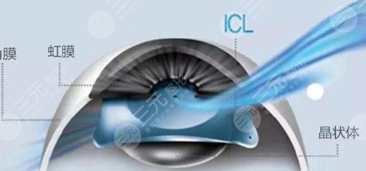 icl晶体