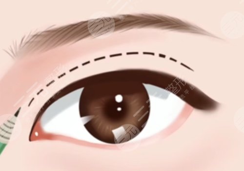 河北医科大学第二医院双眼皮整形做的好吗