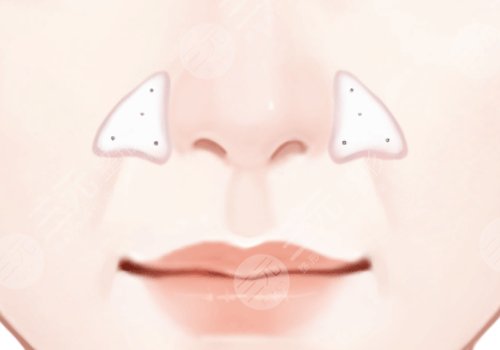 李劲良医生鼻基底是用膨体吗