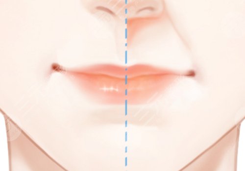 李劲良医生鼻基底是用膨体吗