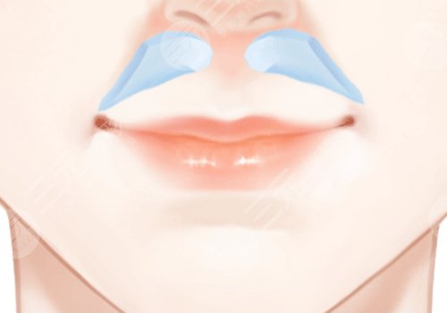 李劲良医生鼻基底是用膨体吗