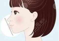 凸嘴手术和正颌手术区别大不大?哪种效果好呢?戳进来看 凸嘴手术和正颌手术区别大不大?哪种效果好呢?戳进来看