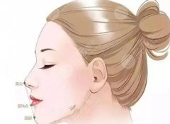 凸嘴手术后悔一辈子?手术原理及注意事项剖析!戳进来看 凸嘴手术后悔一辈子?手术原理及注意事项剖析!戳进来看