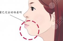 凸嘴手术整容多少钱?有什么好处吗?术后护理方法盘点! 凸嘴手术整容多少钱?有什么好处吗?术后护理方法盘点!
