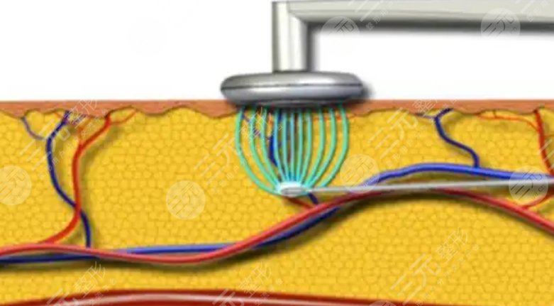 bodytite射频溶脂