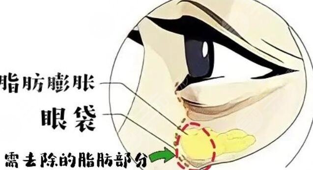 去眼袋