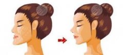 正颌手术后多久可以上班?恢复期大概多久?价格贵不贵? 正颌手术后多久可以上班?恢复期大概多久?价格贵不贵?