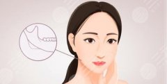 颏成型是几级手术？安全性如何？效果会反弹吗？