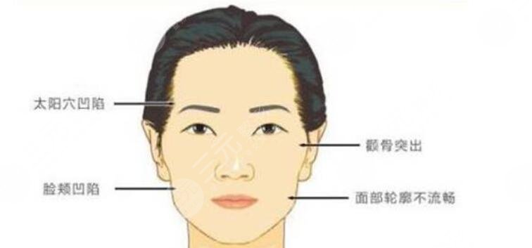 颧骨内推