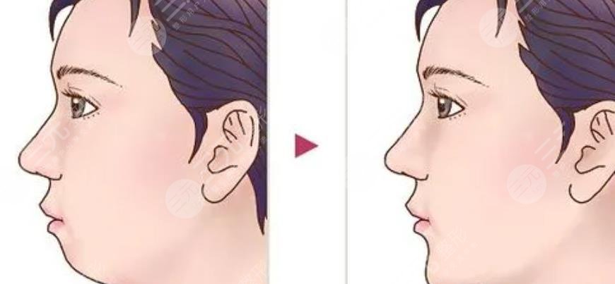 下颌角