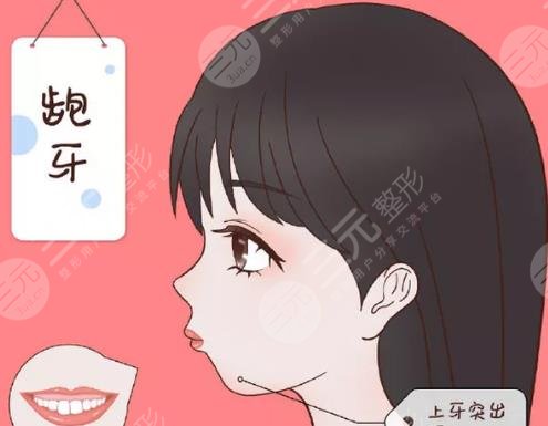 凸嘴矫正