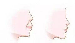 凸嘴矫正后鼻子会不会变挺？来看原理就知道了！流程一览