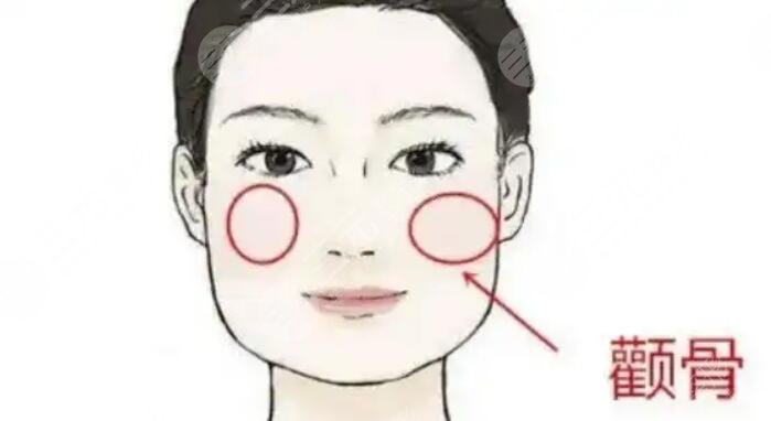 颧骨整形