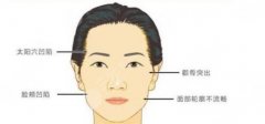 颧弓内推会下垂吗？术后需要修复吗？哪些人不适合做？