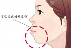 凸嘴手术的危害有哪些？有后遗症吗？看完你还敢做吗？