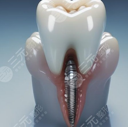 牙齿种植