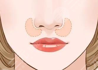 鼻翼