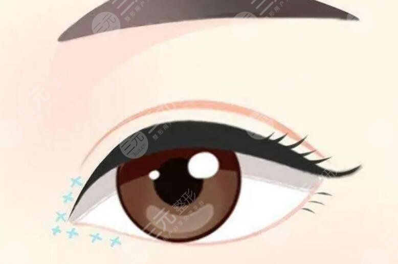 双眼皮修复
