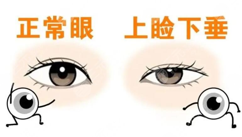 上睑下垂矫正项目
