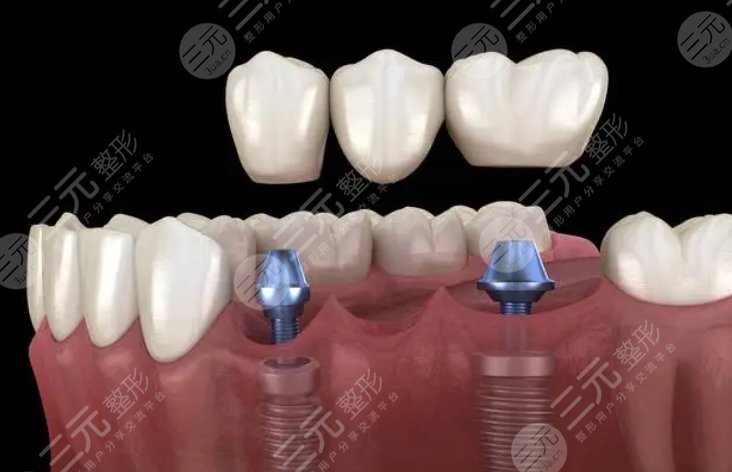 牙齿种植