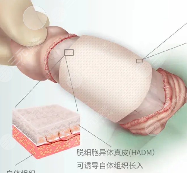 生物补片多少钱生物补片增粗手术多少钱？生物补片增粗手术是什么呢？科普文_https://www.jmylbn.com_品牌排行榜_第5张