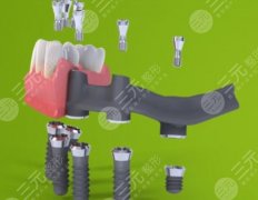 瑞士iti种植牙多少钱一颗？有什么型号吗？看完再决定