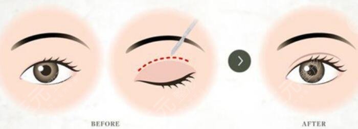 双眼皮修复