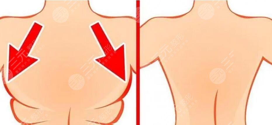 吸脂