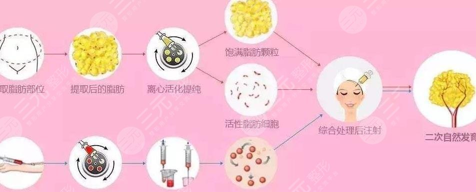 脂肪填充