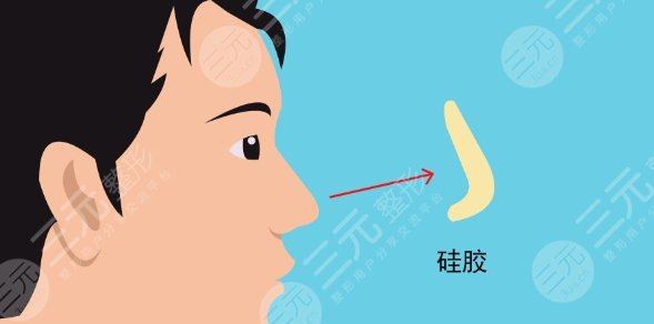 隆鼻