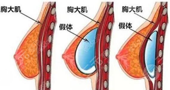 隆胸动漫