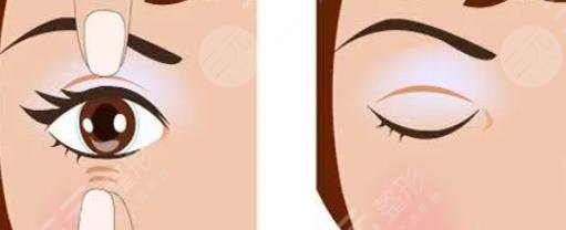双眼皮