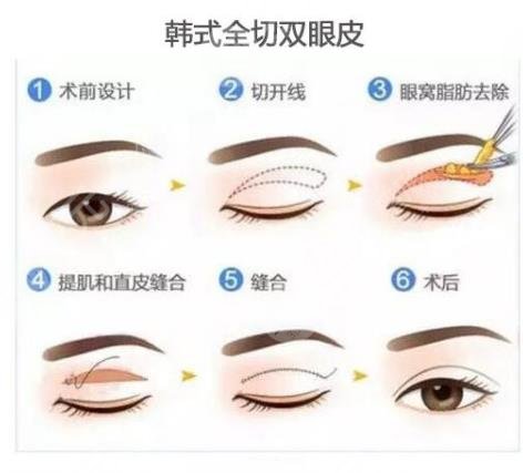 全切双眼皮