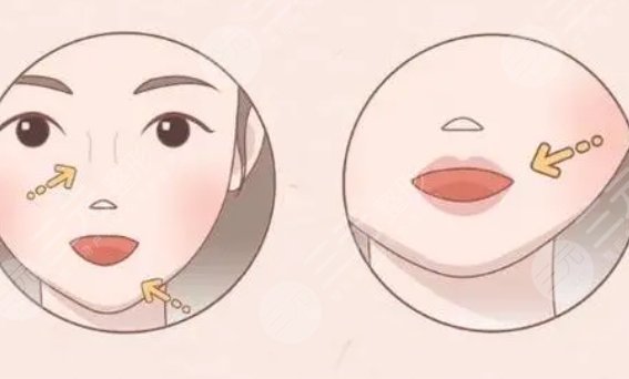 丰唇