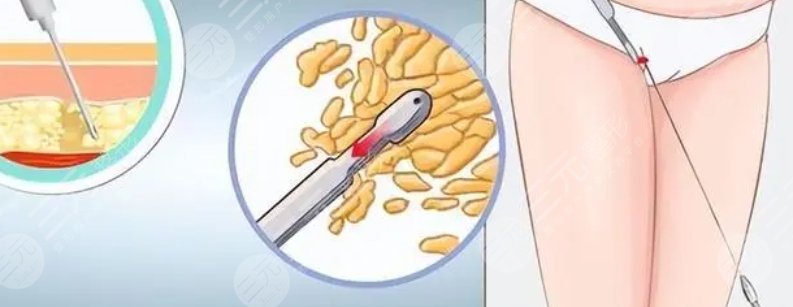 吸脂
