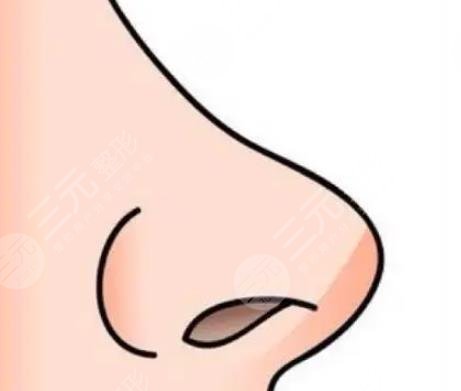 隆鼻