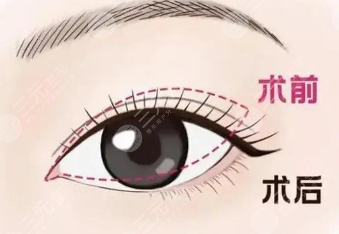 双眼皮
