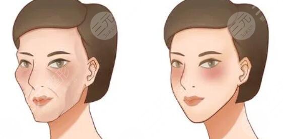 面部填充