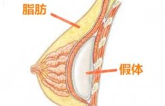 现在隆胸技术安全吗？硅胶假体材料如何选择？
