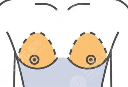 隆胸