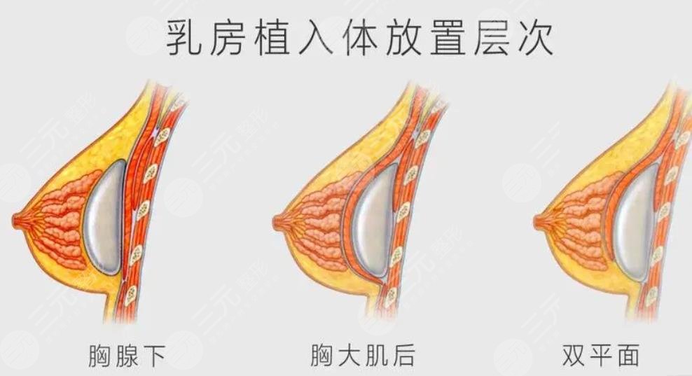 隆胸