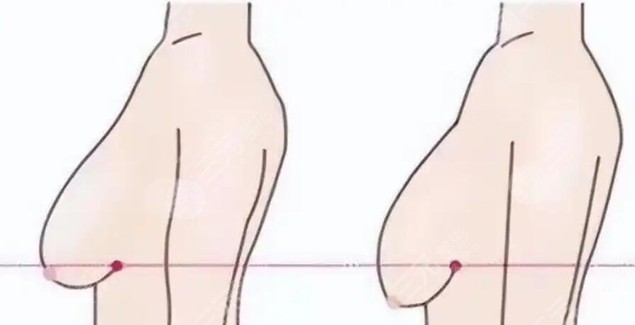 乳房下垂矫正