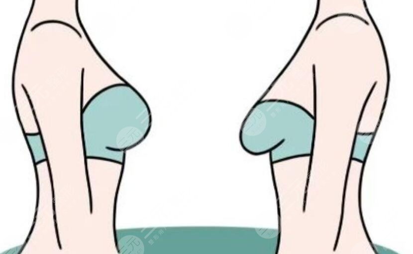 乳房下垂矫正