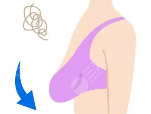 乳房下垂矫正
