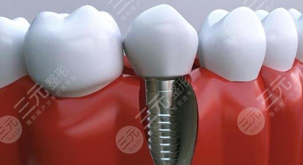 牙齿种植