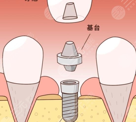 牙齿种植